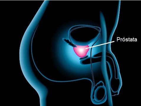 o que é adenocarcinoma acinar da prostata