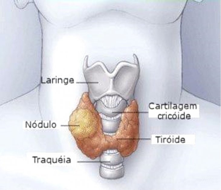 Thyreos - O câncer de mandíbula, é um tipo raro de tumor que se